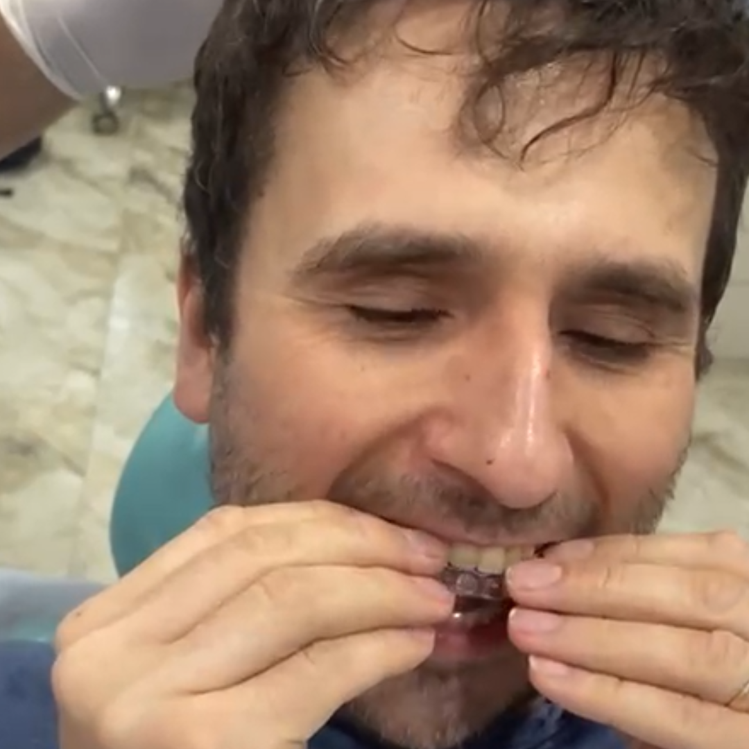 Aligners in Varanasi at Oro Dental Clinic Varanasi